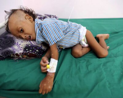Khashoggi contro 50.000 bambini yemeniti massacrati
