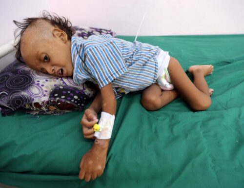 Khashoggi contro 50.000 bambini yemeniti massacrati